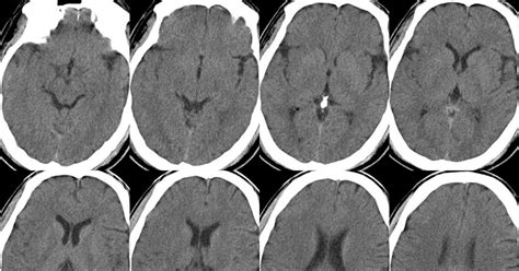 Dr Balaji Anvekar FRCR: Acute MCA infarct Limitations of CT