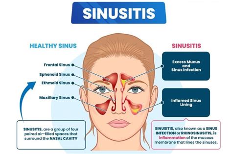 Sinusitis Symptoms Causes And Treatment – NBKomputer