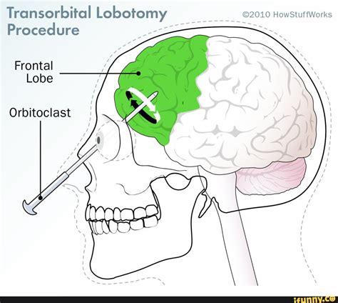 Transorbital Lobotomy HowStuffWorks Procedure Frontal Lobe Orbitoclast ...