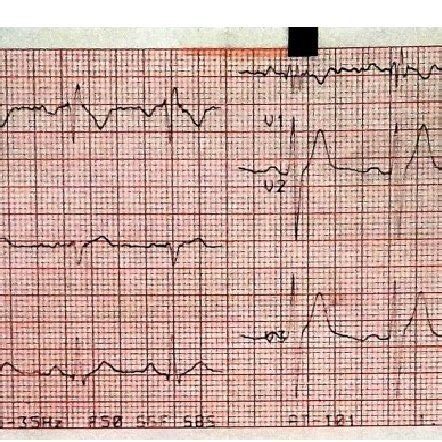 (a-d) Early repolarization syndrome. | Download Scientific Diagram