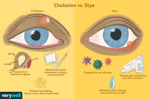 Chalazion vs. Stye: Symptoms, Causes, and Treatment