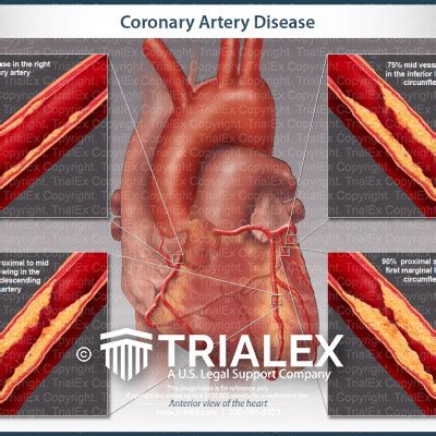 Coronary Artery Disease - TrialExhibits Inc.