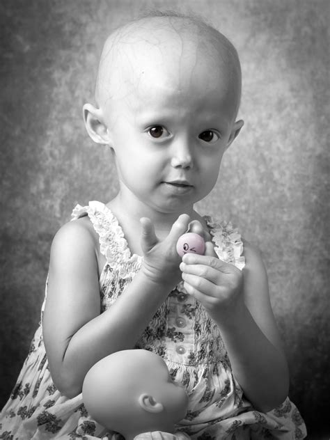 Fajarv: Progeria Disease In India