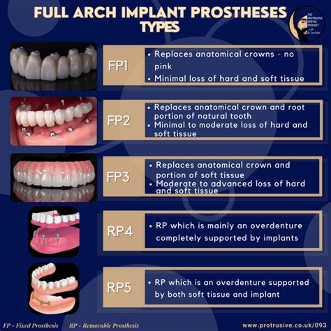 What We Ought To Know About Full Arch Implant Dentistry – PDP093 – Protrusive Dental Podcast