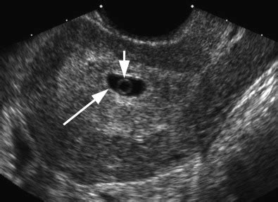 Ultrasound of the Early First Trimester | Obgyn Key