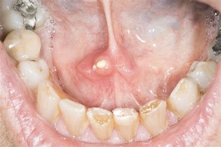 Evaluating salivary gland tumors and diseases - The Clinical Advisor