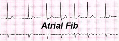 Atrial Fibrillation by Dr John M: Rate control, Rhythm control ...