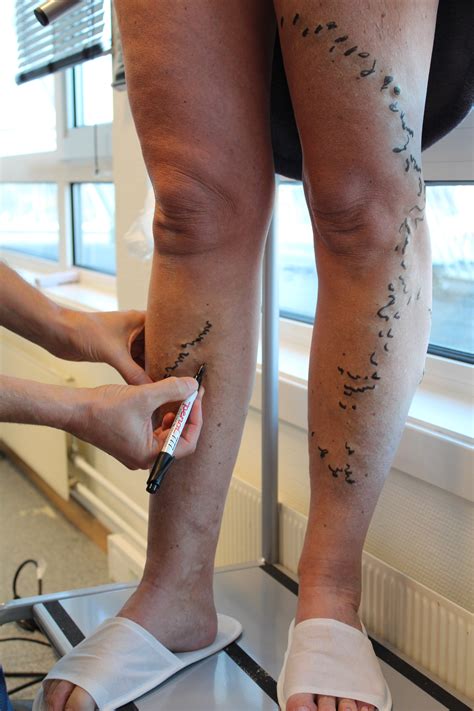 Spider Vein Treatment | Reykjavík Venous Center