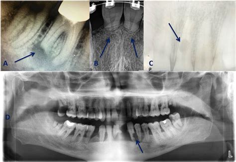 Tooth root resorption: A review - Artak Heboyan, Anna Avetisyan, Mohmed Isaqali Karobari, Anand ...