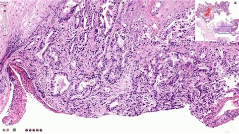 Adenocarcinoma of the Esophagus - Histopathology - YouTube