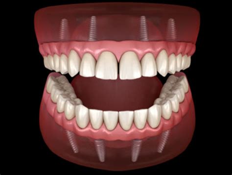 What You Need To Know About All On Four Dental Implants - 2023 Guide - WebSta.ME