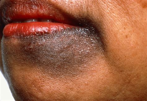 Common Skin Conditions in People of Color: Identification and Treatment - Dermatology Advisor