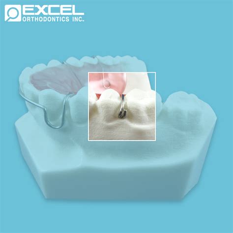 Clasp Options - Excel Orthodontics