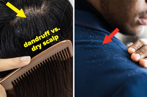 Here’s How To Tell The Difference Between Dandruff And Dry Scalp (And How To Treat Each In The ...