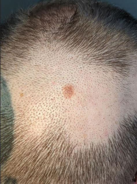 Diagnosed with Stage 1A Melanoma Today (Picture) : Melanoma