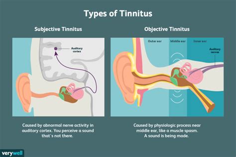 Tinnitus: A small sound causing a big problem | topchiro | Marylebone, London