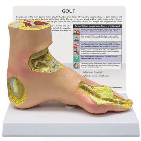 Foot With Gout Anatomy Model | ubicaciondepersonas.cdmx.gob.mx