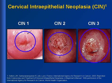 White Lesions On Cervix