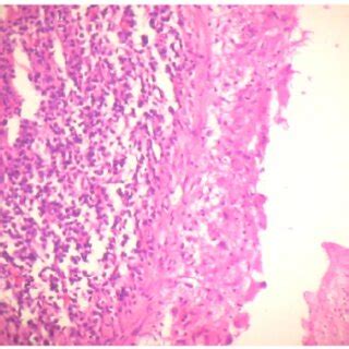 Photomicrograph showing acute and chronic inflammatory exudate in... | Download Scientific Diagram