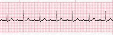First Degree Heart Block - EKG Lesson #316