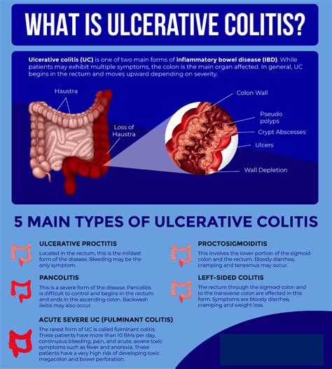 Ulcerative colitis is a relatively common long-term condition that ...