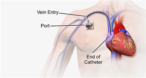 Vascular Access - Dr Peter Vann