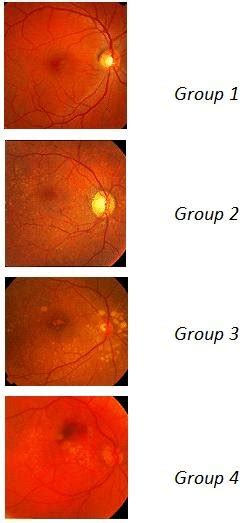 Groups of AMD stages according to 2013 Classification | Download ...