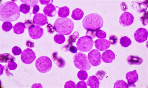Signs of Acute Myeloid Leukemia May Be Present Years Before Diagnosis | Newsroom | Weill Cornell ...