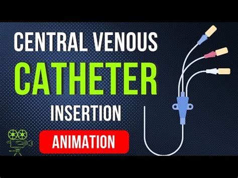 🎬 CENTRAL VENOUS CATHETER (CVC) INSERTION PROCEDURE | ANIMATED ...