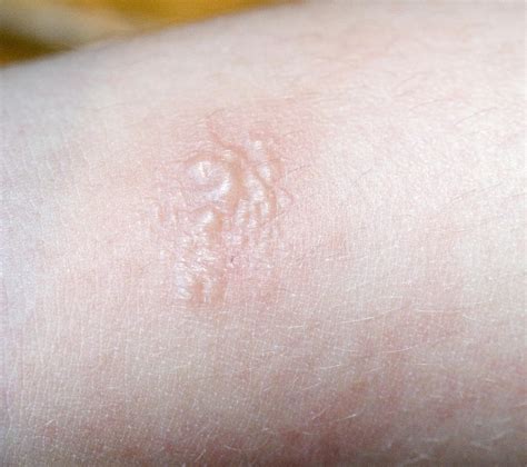 Poison Oak Rash: Symptoms, Treatment, And When To See A, 50% OFF