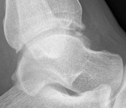 Anterior ankle impingement syndrome | Radiology Reference Article ...