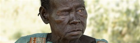 Surviving Leprosy – Sudan Relief Fund