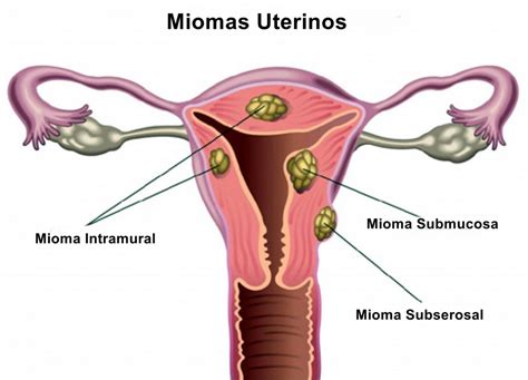 Miomas Uterinos - O que é, Causas, Sintomas e Tratamentos | Dicas de Saúde