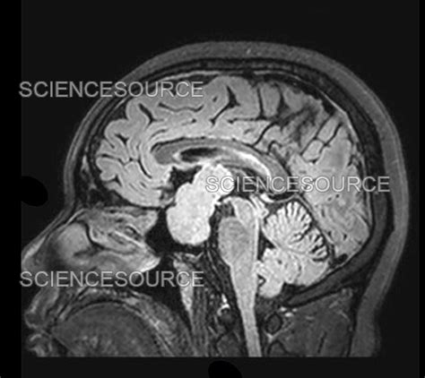 Photograph | Large Pituitary Macroadenoma, MRI | Science Source Images