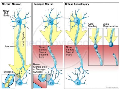 Medmovie.com | Damaged Neurons and Diffuse Axonal Injury