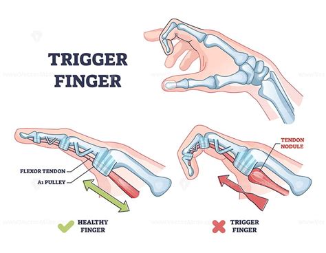 Trigger finger as finger stuck in bent position condition outline ...