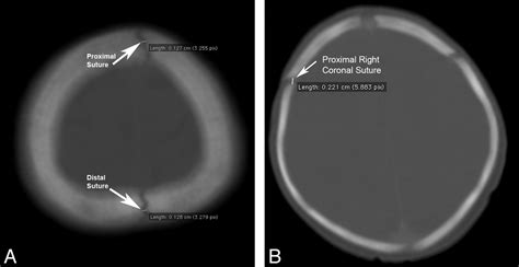 Normal Sagittal and Coronal Suture Widths by Using CT Imaging ...