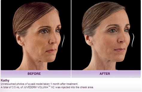 Beverly Hills Med Spa | Los Angeles Juvederm Before After Photos