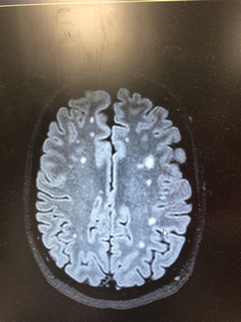 white matter disease mri Mri lesions diffuse axial - Diseases Club center