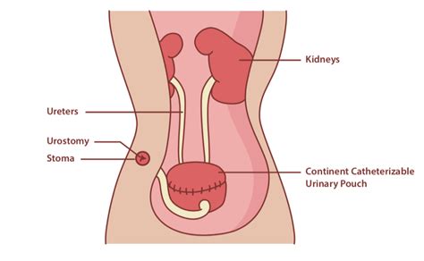 Indiana Pouch: Surgery, Complications and Catheterization - CompactCath