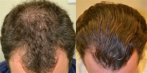 Propecia for Hair Loss - Dr Rogers, New Orleans, LA