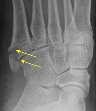 Pseudo-Jones fracture – Radiology Cases