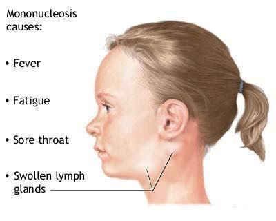 Mono Symptoms – Medical Symptoms Guide