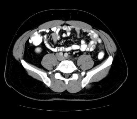 Epiploic appendagitis | Radiology Case | Radiopaedia.org