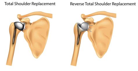 Reverse Total Shoulder Replacement — Adam B. Cohen, MD