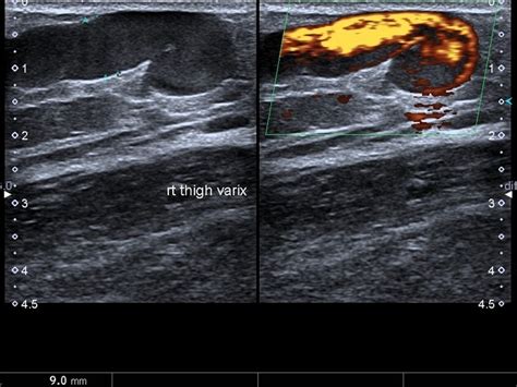 Reticular Veins Chest