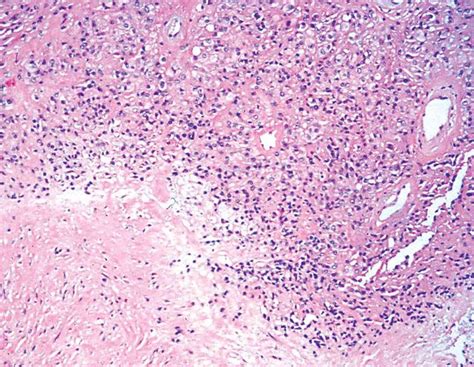 Pathology Outlines - Epithelioid hemangioendothelioma