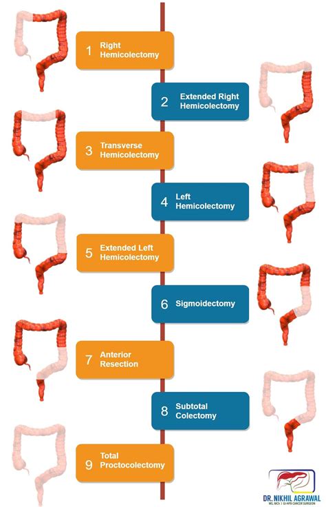 Colon cancer treatment: surgery | Colectomy | Dr. Nikhil Agrawal