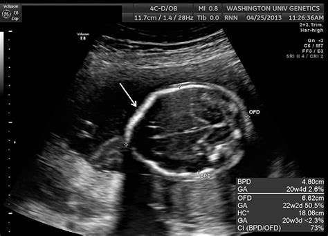 Spina Bifida Ultrasound