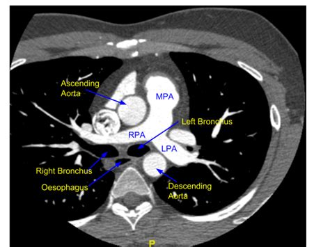 Cardiac CT – Pulmonary artery bifurcation – All About Cardiovascular System and Disorders